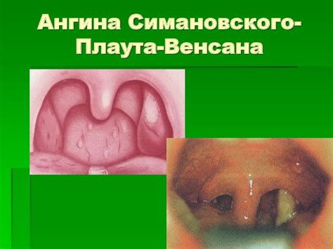 Воспалительные заболевания глотки - презентация онлайн