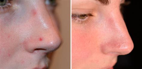 laser mole removal vamp cosmetic clinic