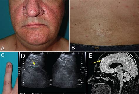 tuberous sclerosis complex cleveland clinic journal  medicine