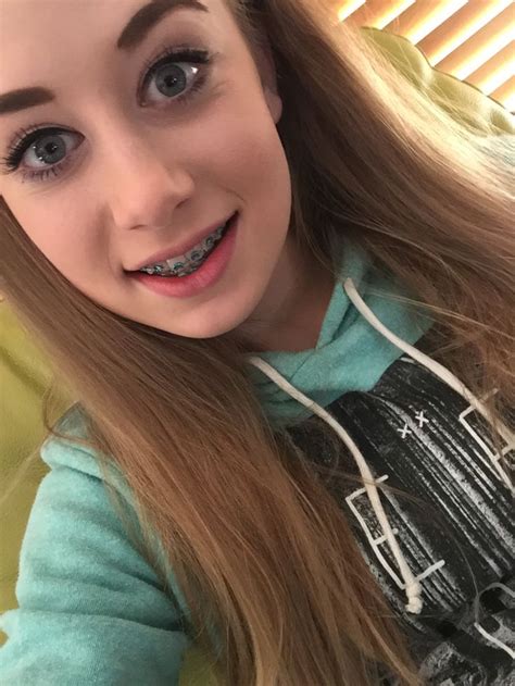 pin auf brace face