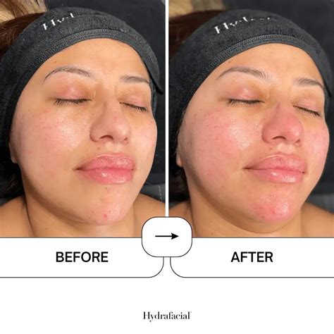 hydrafacial  kent rochester hydrafacial