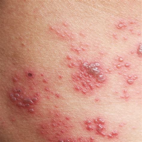 Skin Diseases Holes