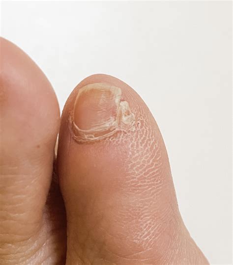 Can You Fix Curved Toenails at Christopher Brunell blog