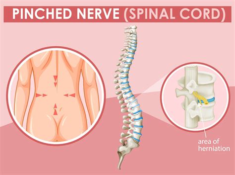 Royal Palm Beach Chiropractor explains what is a pinched nerve.