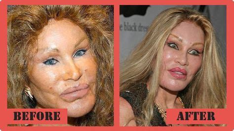 How Plastic Surgery Created The Catwoman Lovely Surge - vrogue.co