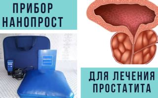 Нанопрост: цена прибора, отзывы женщин о лечении