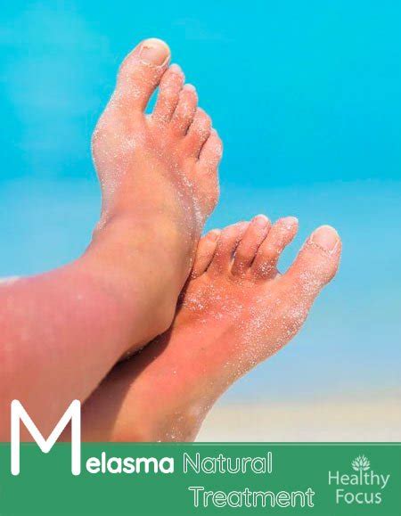 Melasma Natural Treatment - Healthy Focus