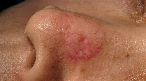 skin cancer  face early signs