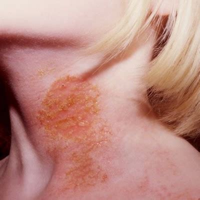 IMPETIGO