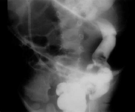 Barium enema: " bird beak sign " at the splenic flexure. | Download ...