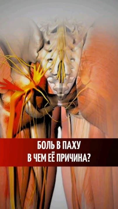Боль в паху. В чем её причина? #больвпаху #тазобедренныйсустав # ...