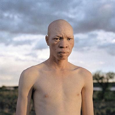 Les albinos d'Afrique mutilés et assassinés pour leur couleur