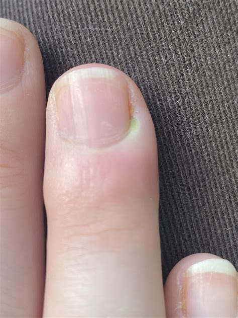 what to do with an infected hangnail? : r/nailhealth