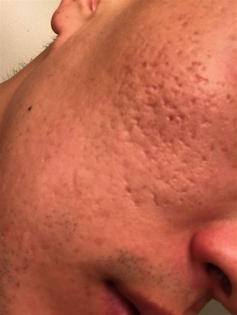 Please suggest acne scar treatment – Scar treatments – Acne.org Forum