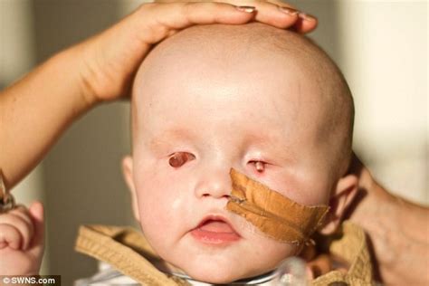 Жизнь человека без одного глаза: адаптация, преодоление трудностей и ...