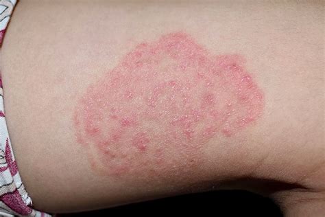 Diabetes and Skin Problems: Know About Diabetic Skin Disorder Causes ...
