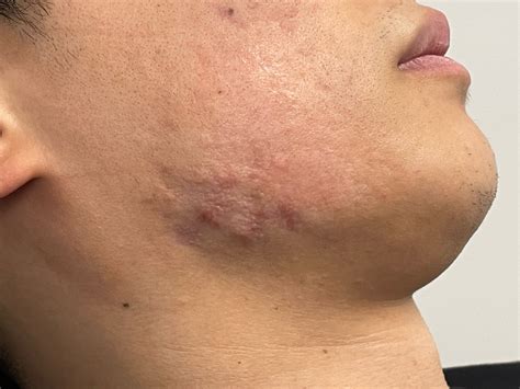 Steroids Side Effects Acne