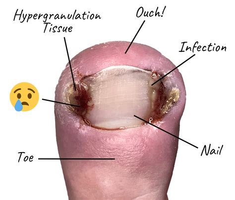 Ingrown Nail Diagram