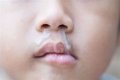 Rhinorrhea - Definition of Rhinorrhea