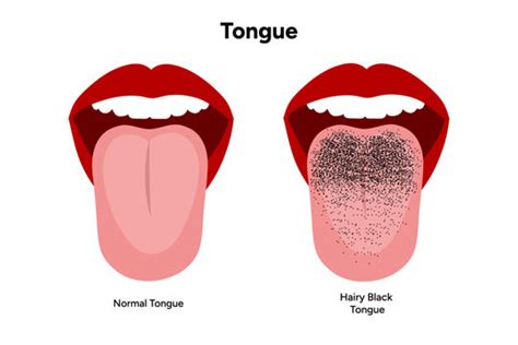 how to get rid of black hairy tongue