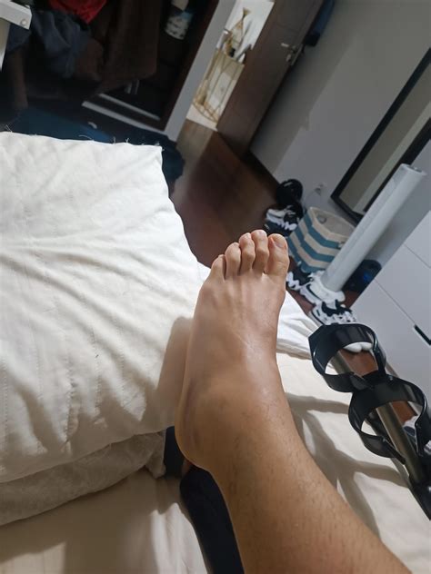 Sprained ankle : r/sprainedankles
