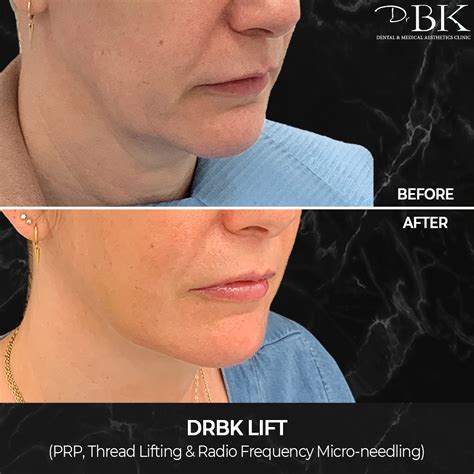 Non Surgical Face Lift For Jowls at Renee McConnell blog