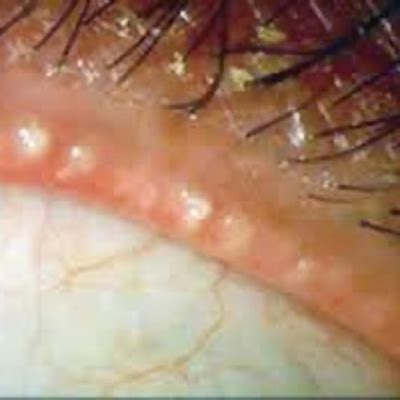 meibomian gland disease archives eyeworld