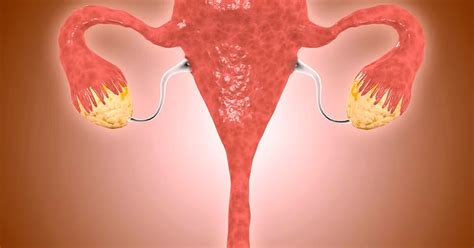 The Impact Of Polycystic Ovary Syndrome On Women's Health And Well-Being