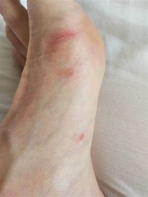 Vibram Five Fingers: every time I run through a moist terrain and the