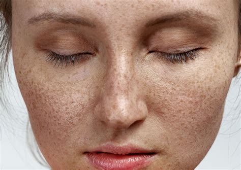 What are freckles? - Da Vinci Clinic