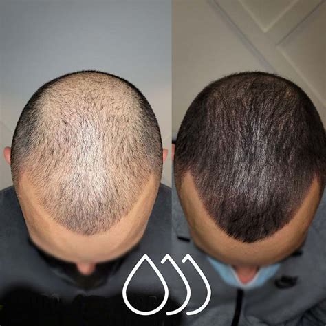 scalp micropigmentation cost near me - Maricela Beyer