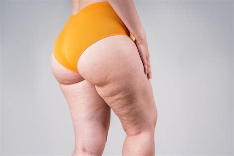 How Does MTF Hip Widening Surgery Differ From Other Gender-Affirming ...