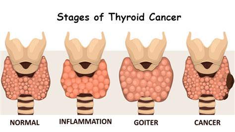 Thyroid cancer surgery specialist in Thane, Thyroid cancer hopsital in ...