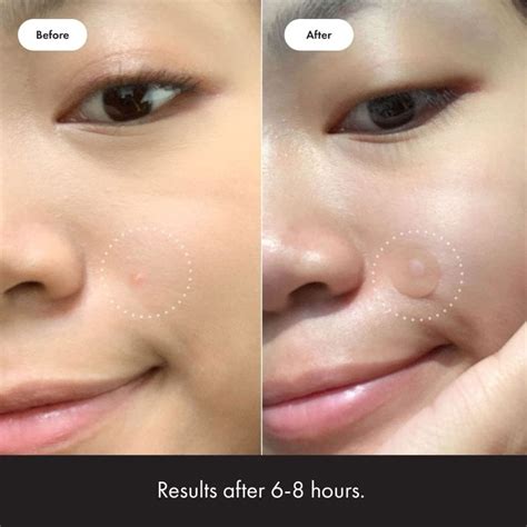 Zap Those Zits Away: 9 Best Pimple Patches You Need in Your Life!