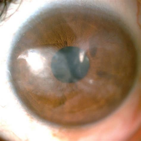 Corneal Ulcer Scar