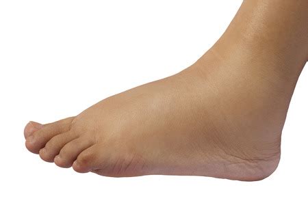 Oh, Your Swollen Feet! - Solon Podiatrist