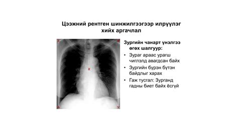 Долмалин - Цээжний рентген зураг унших, дүгнэлт хийх арга...