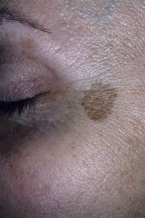 Lentigines on the Face Pictures – 21 Photos & Images / illnessee.com
