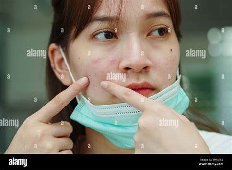 Girl with scar hi-res stock photography and images - Alamy