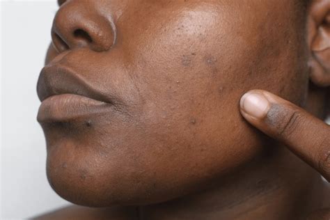 black spots  face african american sale wwwmetaltecnicacompe
