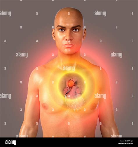 Aortic aneurysm. Computer illustration showing an aneurysm in the ...