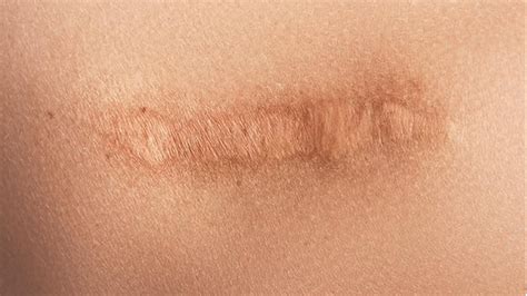 prevent scarring wound care matters
