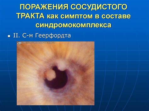 Заболевания сосудистой оболочки - презентация онлайн