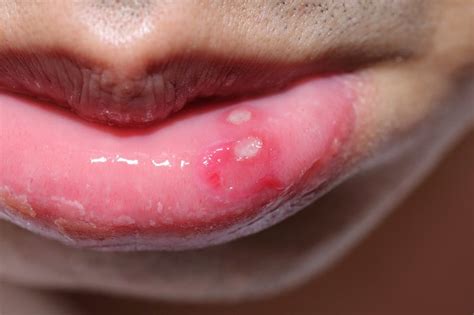Herpes On Inner Lip