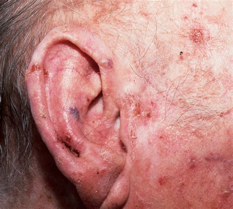Symptoms Of Skin Cancer On Face