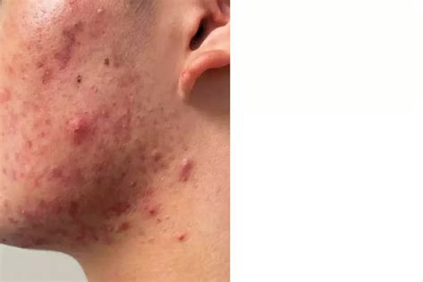 A teenager with facial papules and pustules | Medicine Today
