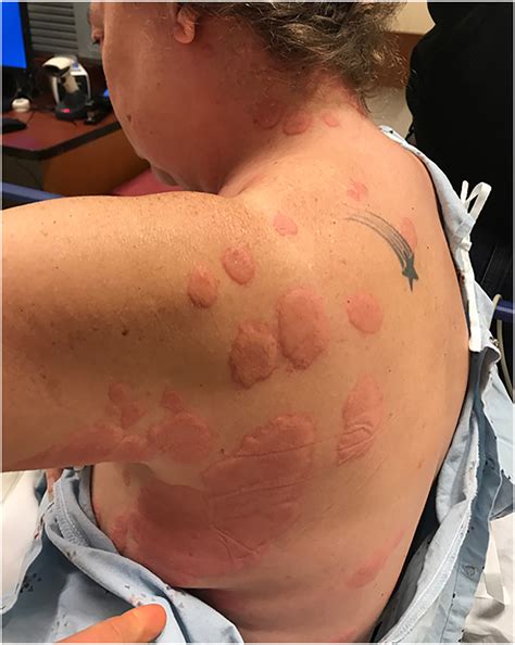 Neutrophilic Urticarial Dermatosis Figure 1 From Systemic Lupus