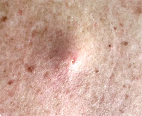 epidermoid cyst symptoms   treatment