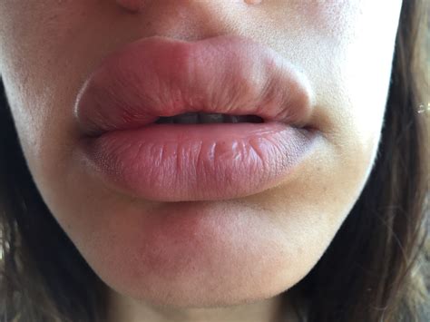 Big Lips with Juvederm Are Not Always Better Lips - Orange County, CA