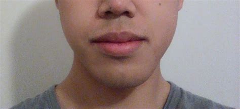 I have an asymmetrical smile; is surgery an option? : r/Dentistry